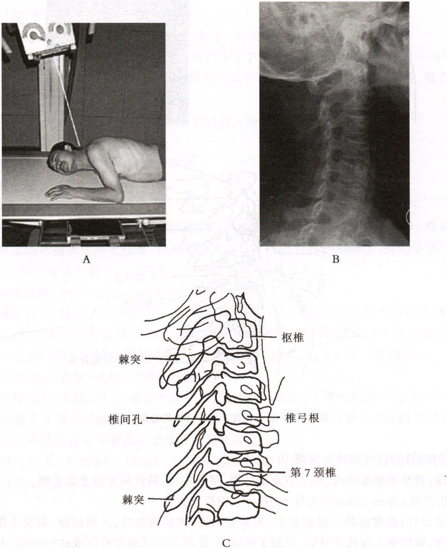 颈椎斜位的两种摆位方式怎么看椎间孔？ - 知乎